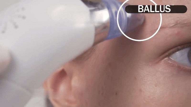 Blackhead Remover Tool 💆‍♀